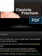 Clavicle Fracture