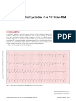 A Wide QRS Tachycardia in A 17-Year-Old