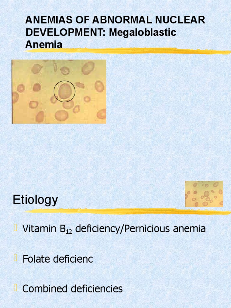 Anemias of Abnormal Nuclear DEVELOPMENT Megaloblastic Anemia PDF