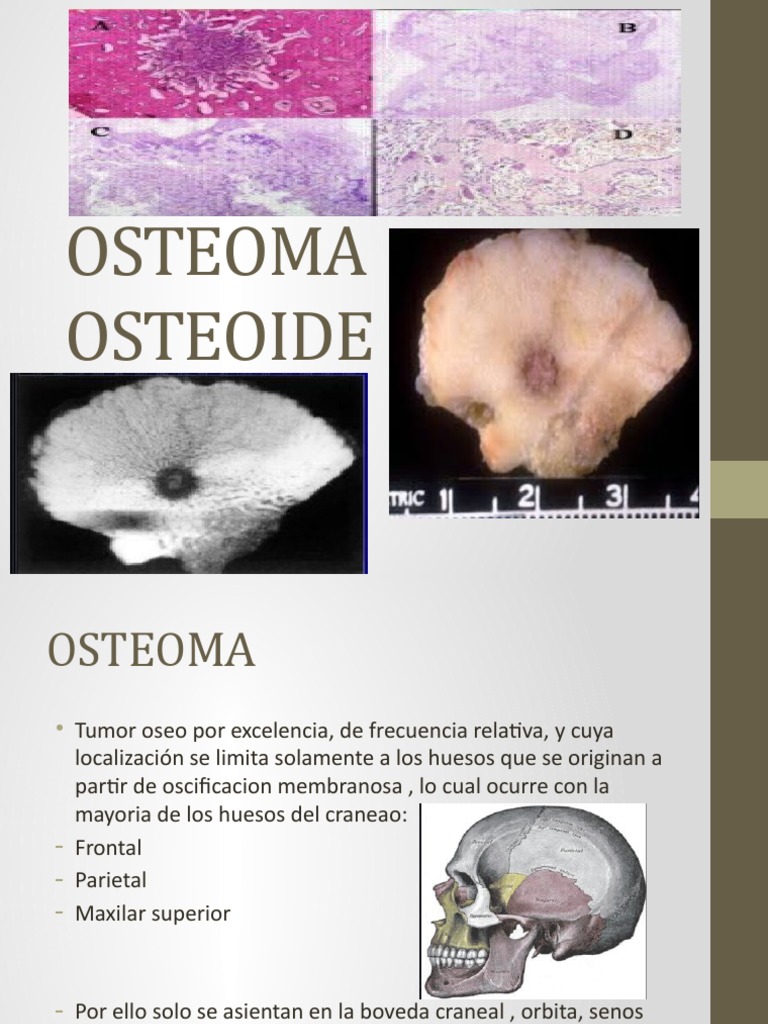 Osteoma Osteoide PDF Hueso Neoplasias