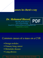 Lung Masses in Chest X Ray