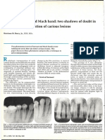 Cervical Burnout and Mach Band: Two Shadows of Doubt in Radiologic Interpretation of Carious Lesions