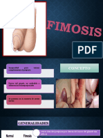 FIMOSIS Varicocele