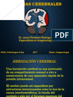 herniacioncerebral-170930173045