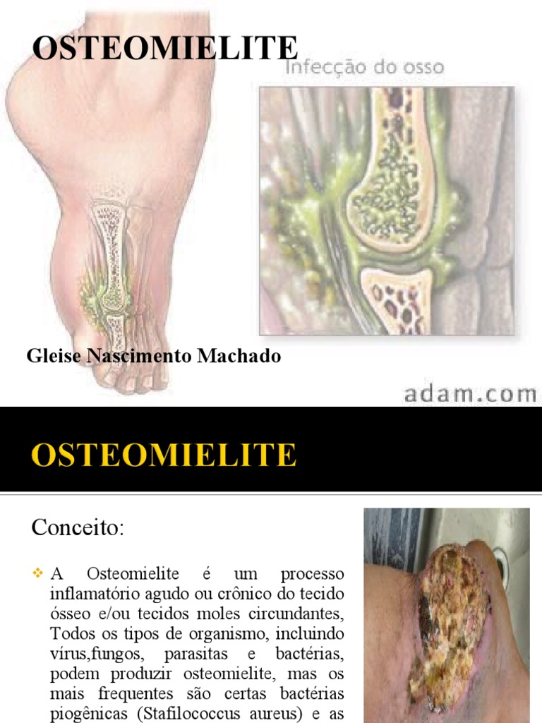 Osteomielite: Causas, Sintomas e Tratamento | PDF | Câncer ...