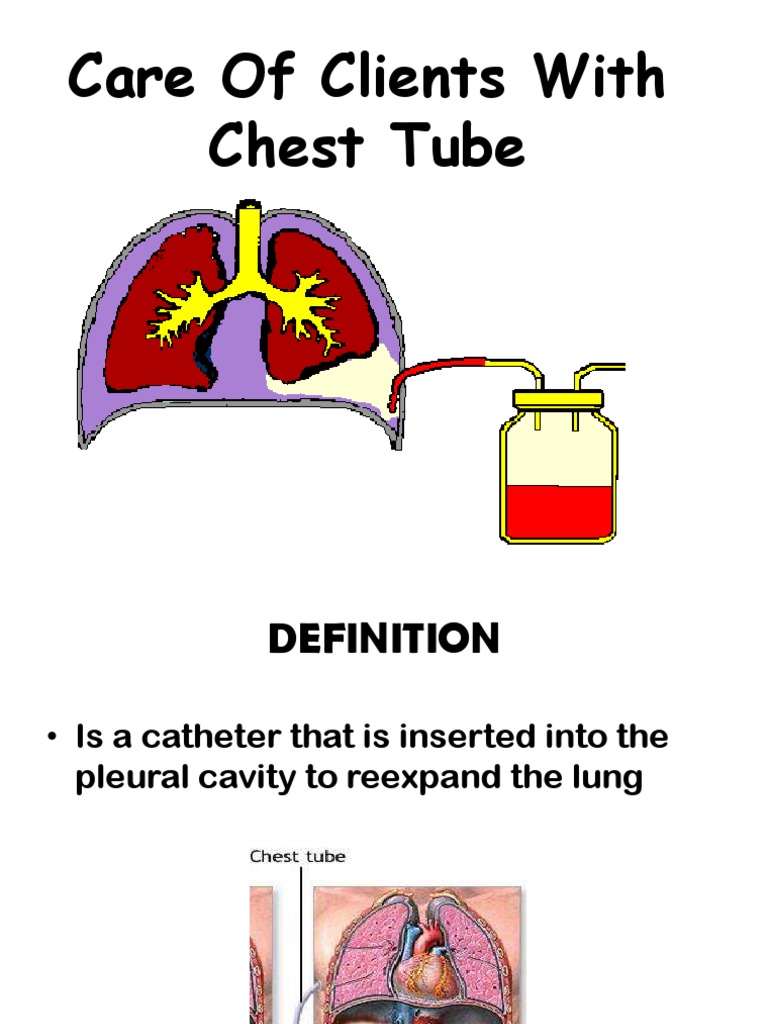 Care and Management of Patients with Chest Tubes A Comprehensive Guide