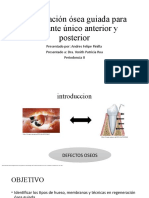 Regeneración Ósea Guiada para Implante Único Anterior y