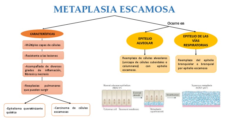 Metaplasia Escamosa | PDF