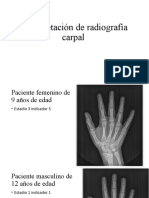 Interpretación de Radiografía Carpal