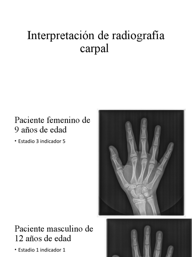 Radiografías carpales en niños de 9 a 12 años | PDF