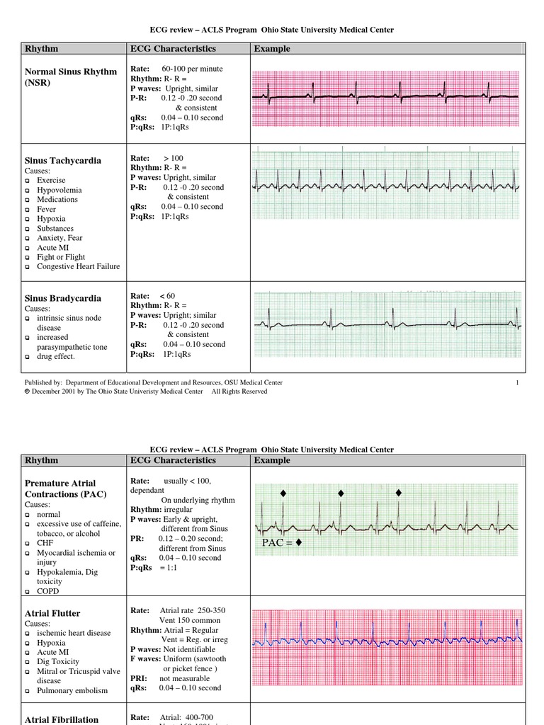Rhythm ECG Characteristics Example Normal Sinus Rhythm (NSR) | PDF ...