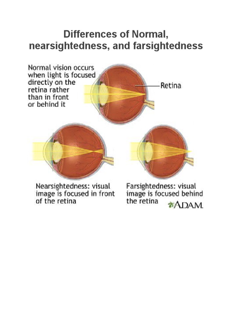 Understanding Nearsightedness and Farsightedness | PDF | Glasses