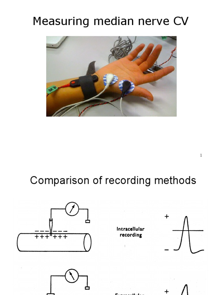 Measuring Median Nerve CV | PDF | Electromyography | Neuron