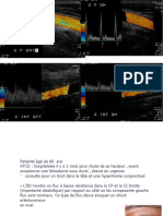 Fistule Carotido Caverneuse