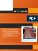DR - JD - Gemelli - Fetal Demise