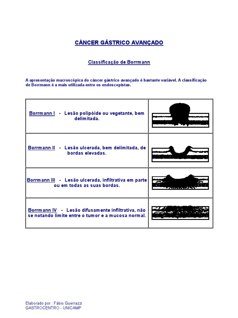 Classificação de Borrmann no Câncer Gástrico | PDF | Neoplasmas ...