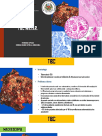 TBC miliar: patología pulmonar