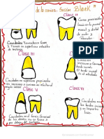 Clasificación de Las Caries Según Black