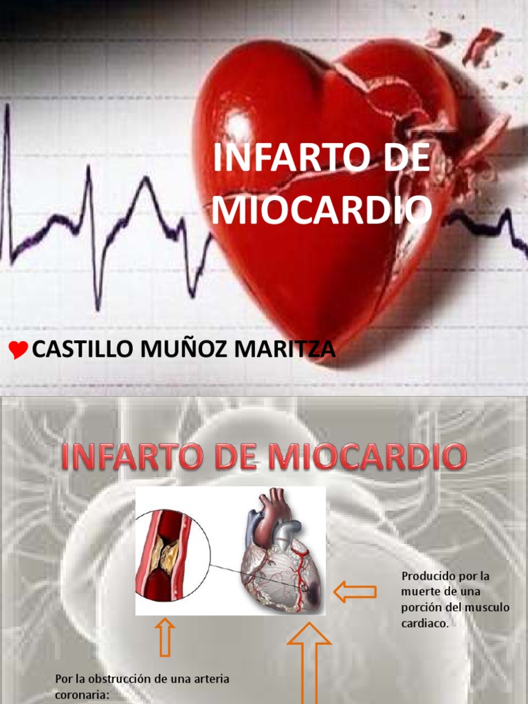Clasificación y Manejo del Infarto al Miocardio | PDF | Infarto de ...