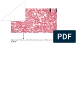 Degeneração Gordurosa PDF