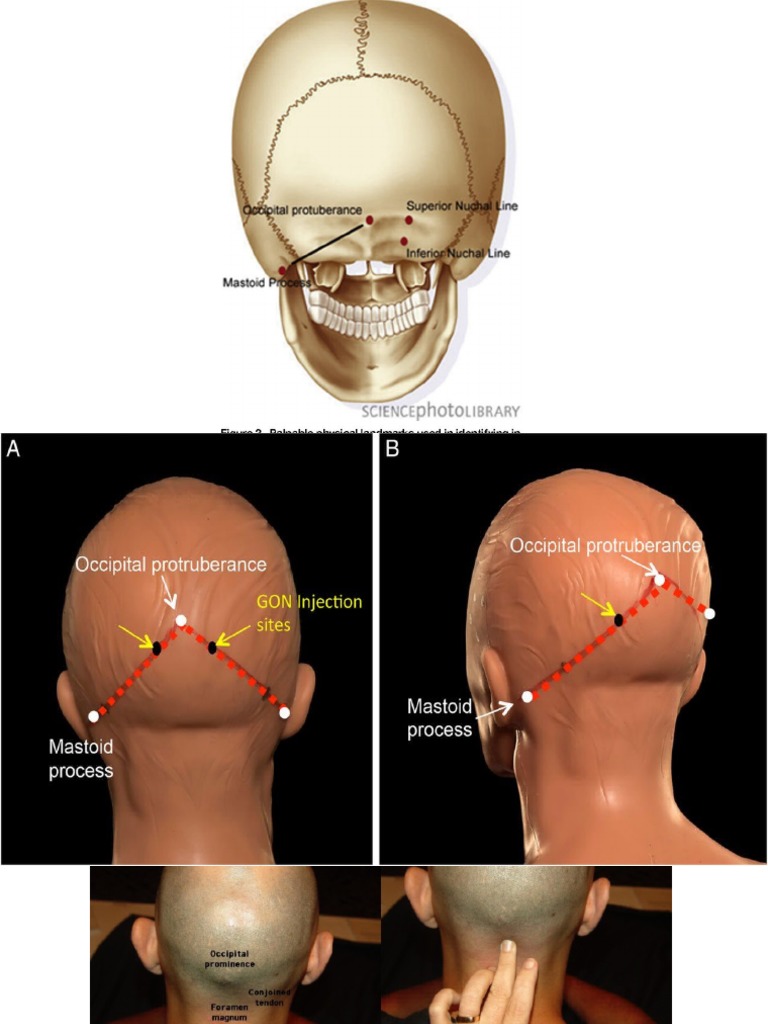 Greater Occipital Nerve Injection Guide | PDF