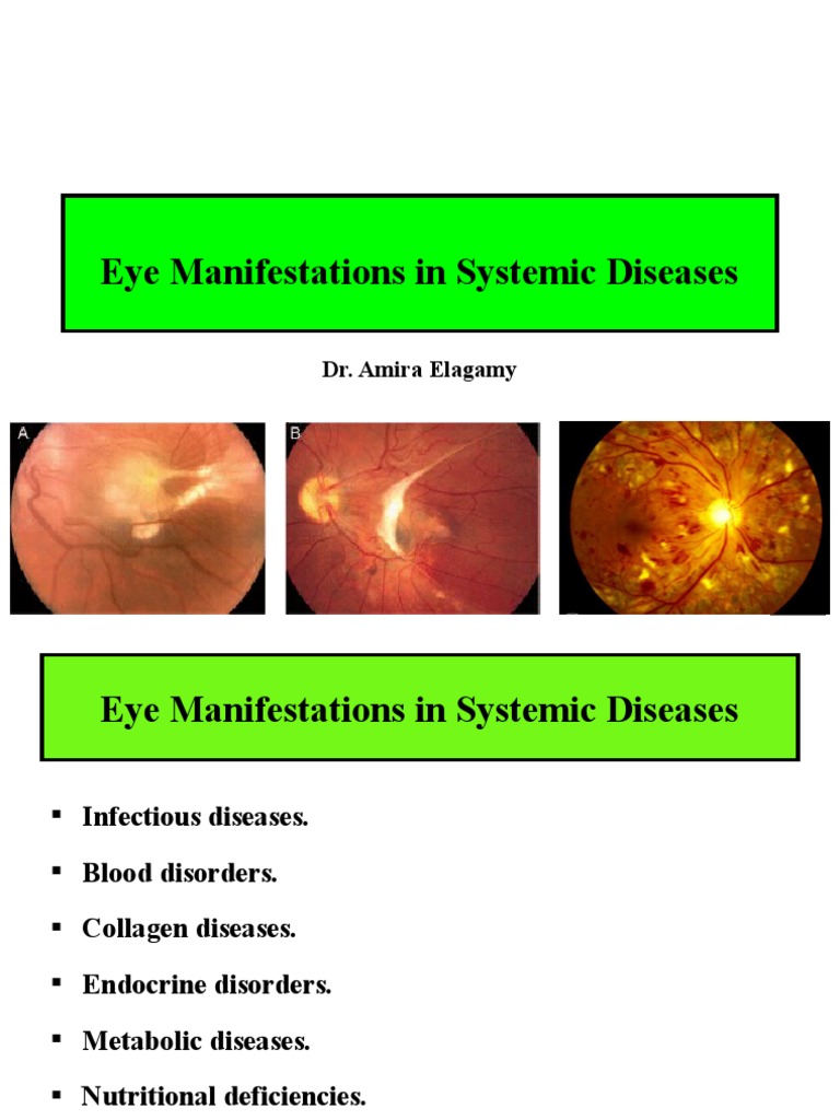 Ocular Manifestations of Systemic Diseases | PDF | Retina | Cataract