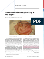 An Embedded Earring Backing in The Tragus: Otoscopic Clinic