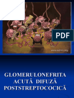 Glomerulonefrita Acuta