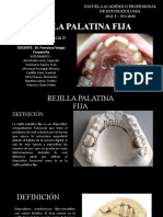 Rejilla Palatina Fija Ortodoncia
