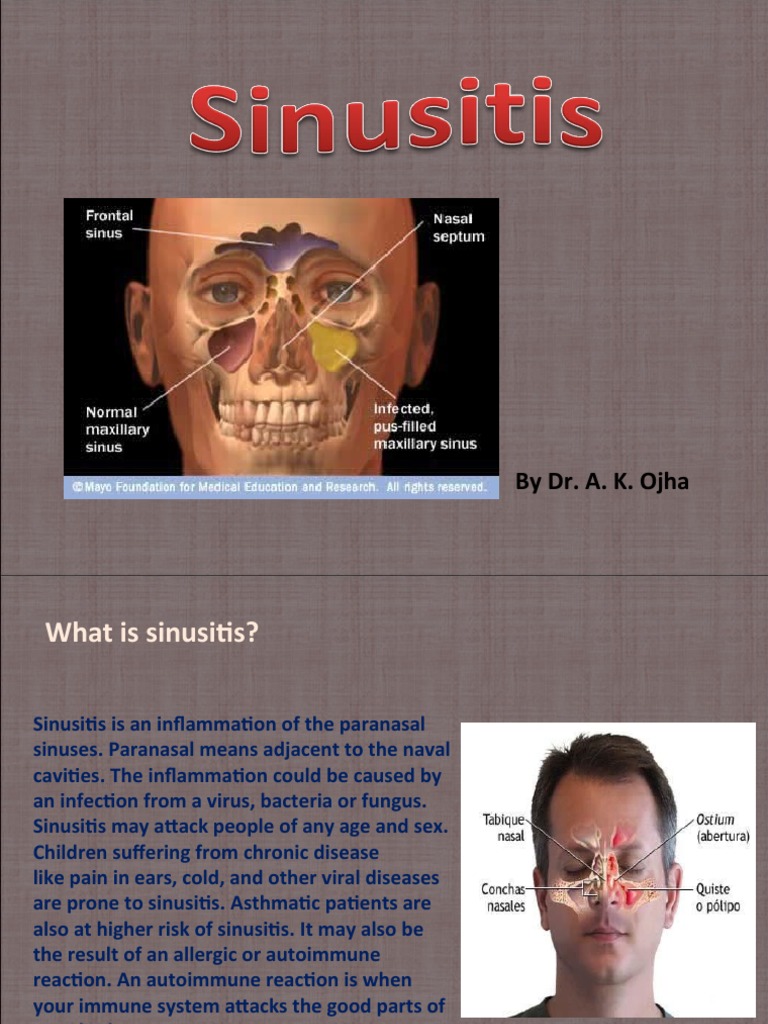 Understanding Sinusitis and Its Treatments | PDF | Clinical Medicine ...