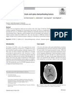 Sars-Cov-2 Can Induce Brain and Spine Demyelinating Lesions: Case Report