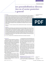 Restauraciones Posendodónticas Directas Con Composites en El Sector Posterior, Una Revisión General