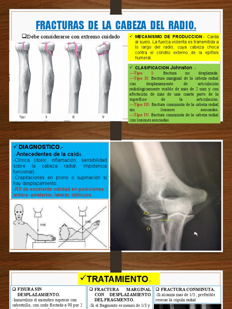 Clasificación de fracturas de cabeza radial | PDF | Mano | Sistema ...