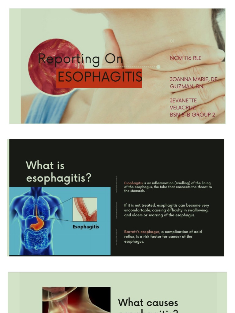ESOPHAGITIS | PDF