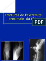 03 - Fractures Proximales Du Tibia