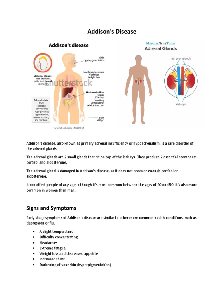 Addison's Disease 1 | PDF | Adrenal Gland | Adrenocorticotropic Hormone