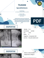 Tilikan Spondilolistesis