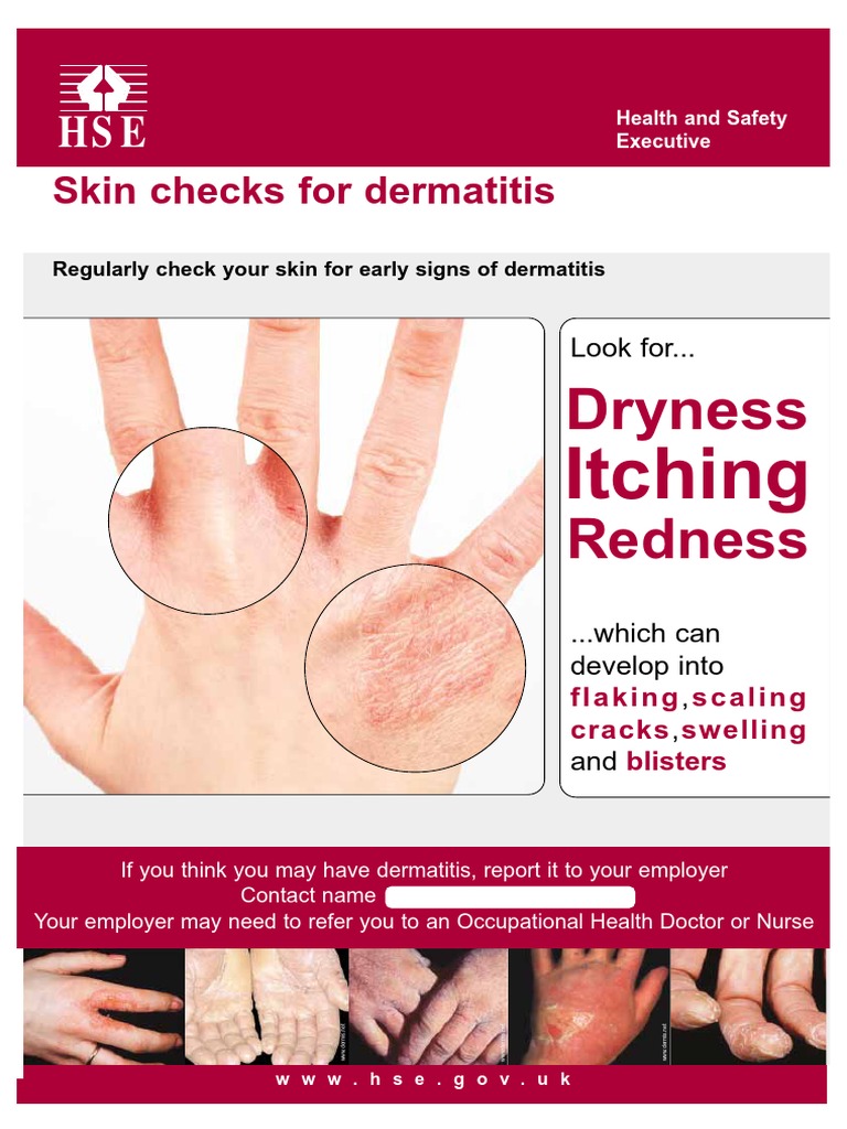 HSE Guide to Skin Checks for Early Dermatitis Signs | PDF