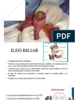 Ileo biliar: obstrucción intestinal por cálculos biliares