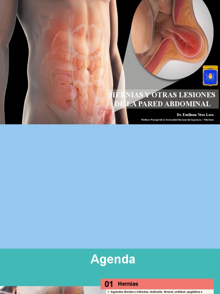 Hernias y Otras Lesiones de La Pared Abdominal | PDF | Sarcoma | Abdomen