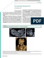 Exencephaly-Anencephaly Sequence: Consult Series