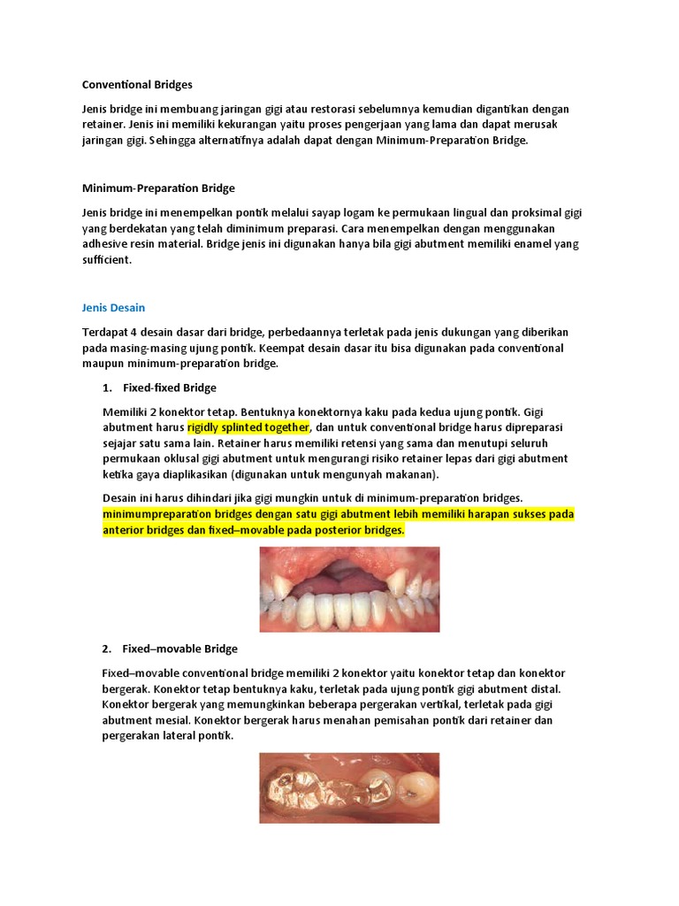 Jembatan Gigi: Fixed-Movable Bridge | PDF