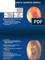 OTITA SUPURATA CRONICA SIMPLA