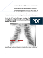 Figure # 6. The Red Arrows Point To Typical Air Bronchograms in A Patient With A Segmental Pneumonia. Note There Is No