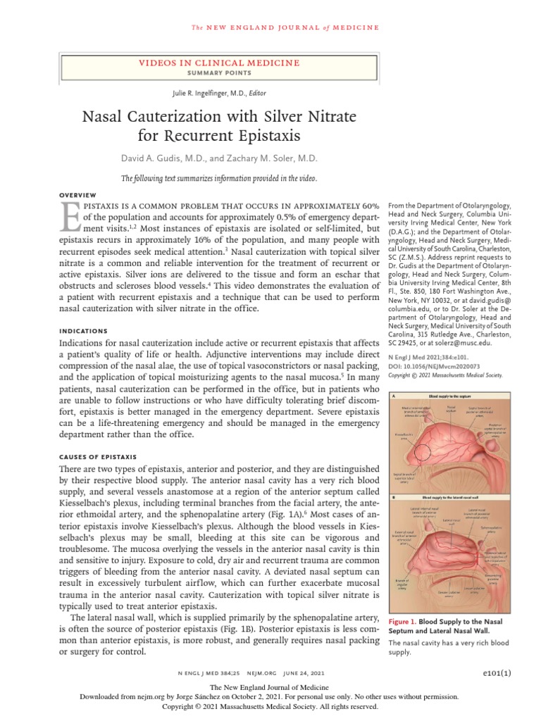 Nasal Cauterization With Silver Nitrate For Recurrent Epistaxis PDF Clinical Medicine