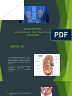 Hidronefrosis: definición, embriología, anatomía, fisiopatología, etiología, cuadro clínico, diagnóstico y tratamiento