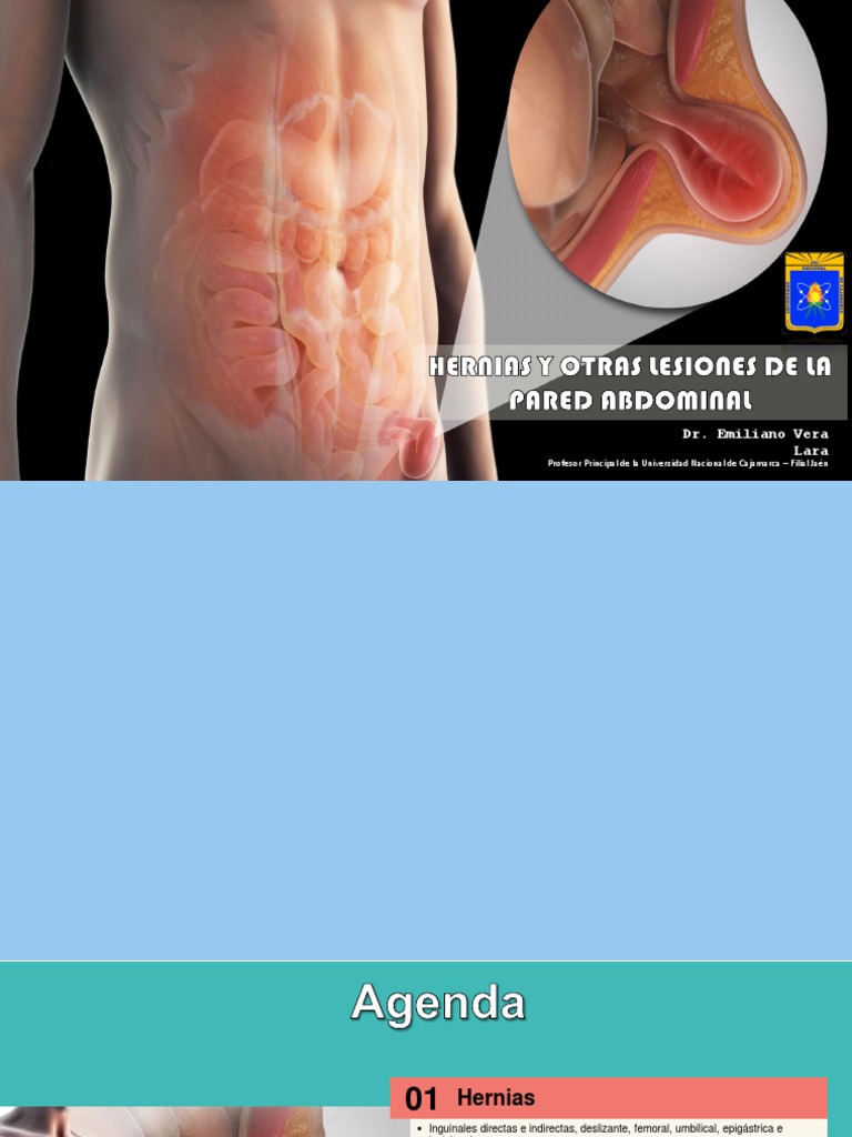 Hernias y Otras Lesiones de La Pared Abdominal | PDF | Sarcoma | Abdomen