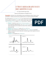 Datos Electrocardiagraficos en Pericarditis e Iam