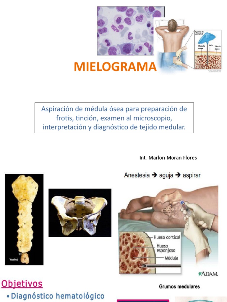 MIELOGRAMA | PDF