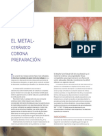 Ventajas y preparación de coronas de metal-cerámica